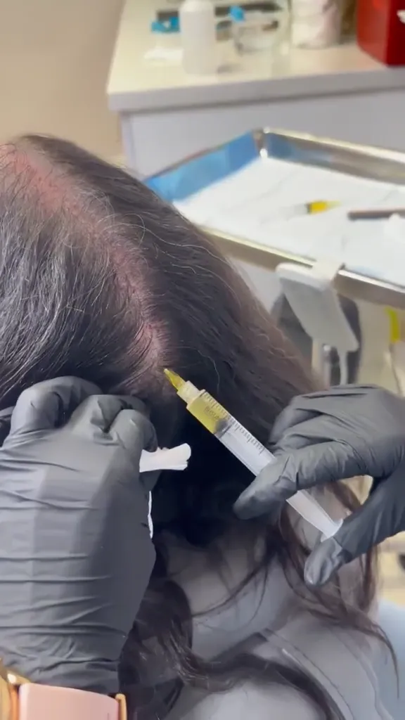 Capillary Plasma Injections with Microneedling