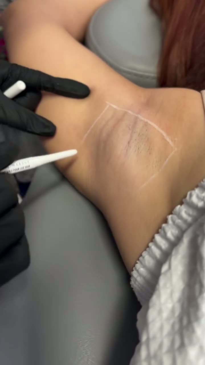 Hyperhidrosis Treatment