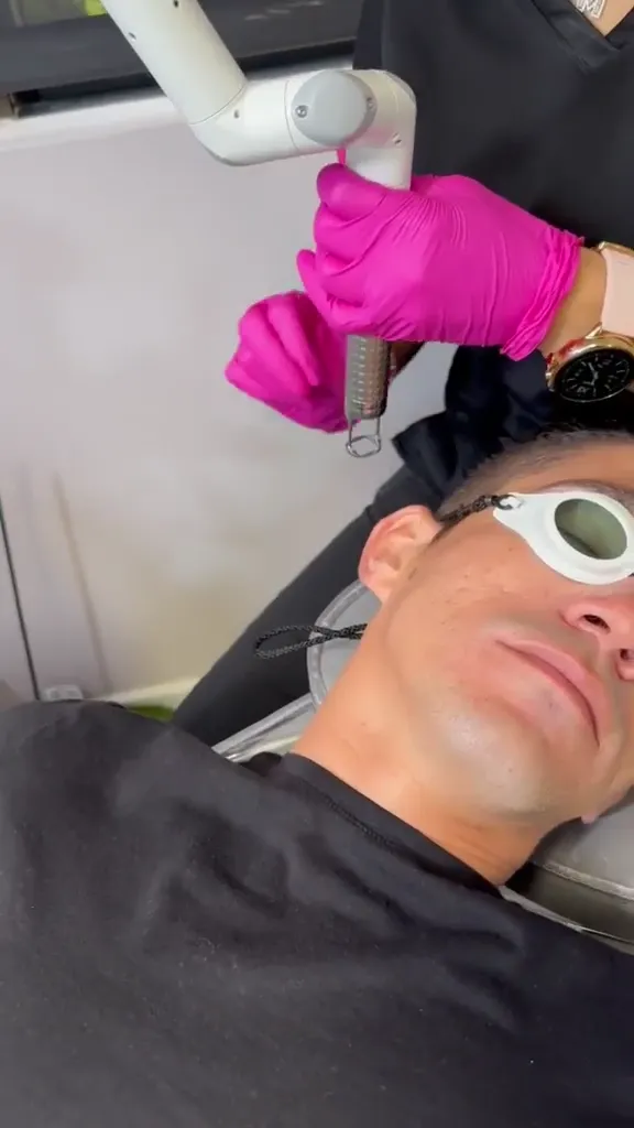 Acne Scar Treatment