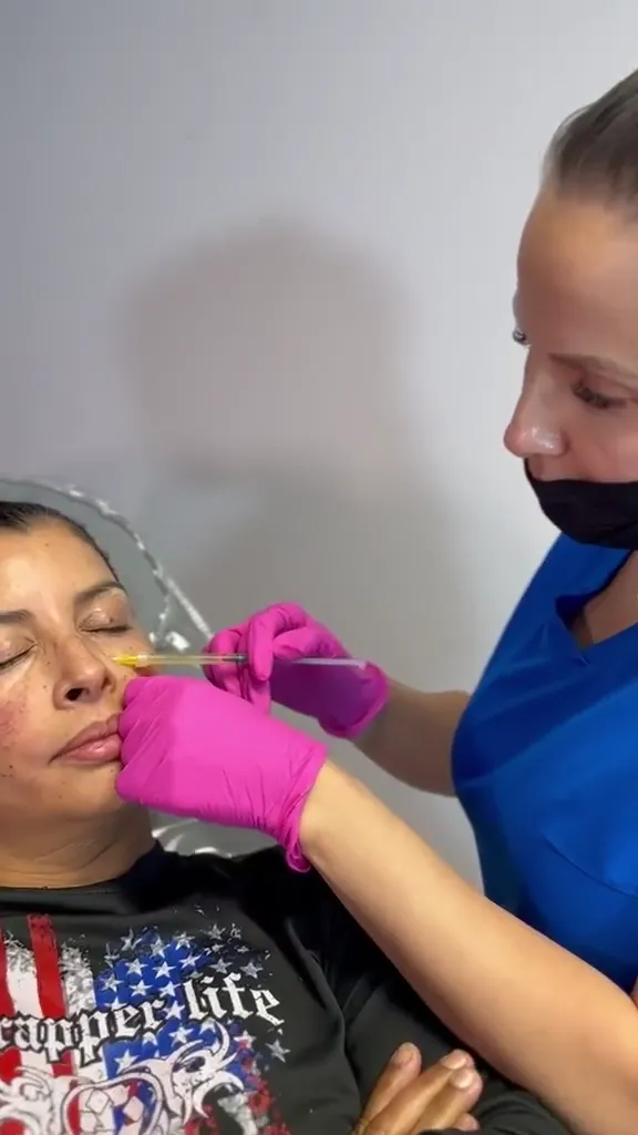 Full-Face Plasma Injections with Microneedling