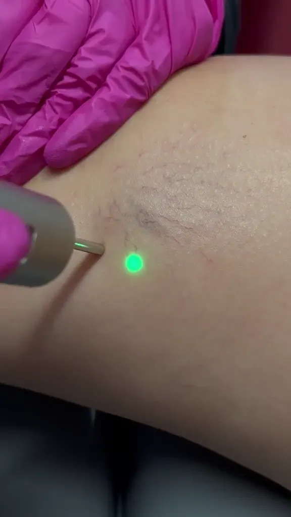 Spider Vein Laser