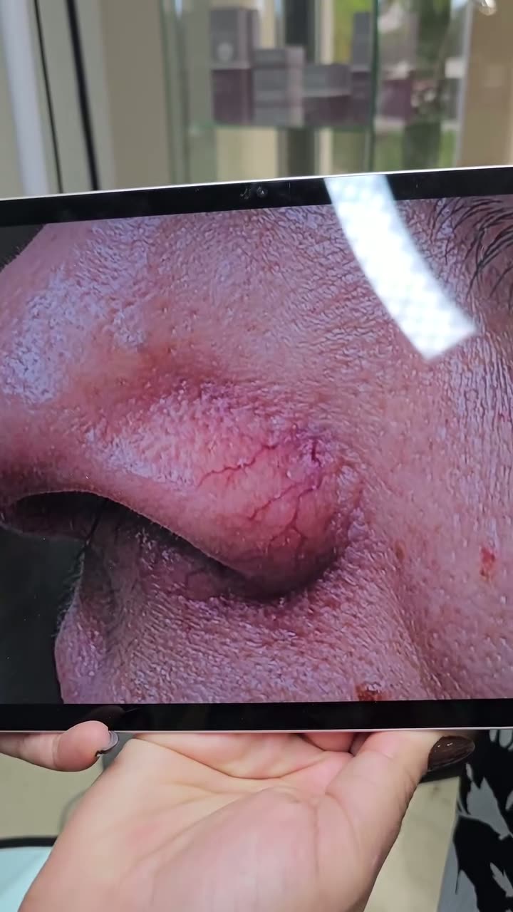 Spider Vein Laser